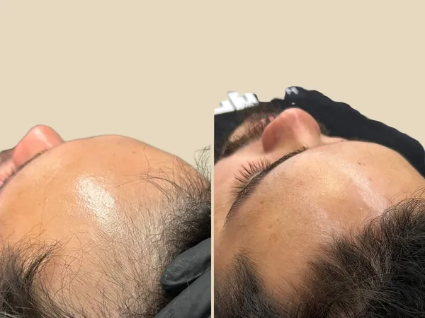 Comparativo da linha frontal do cabelo em perfil