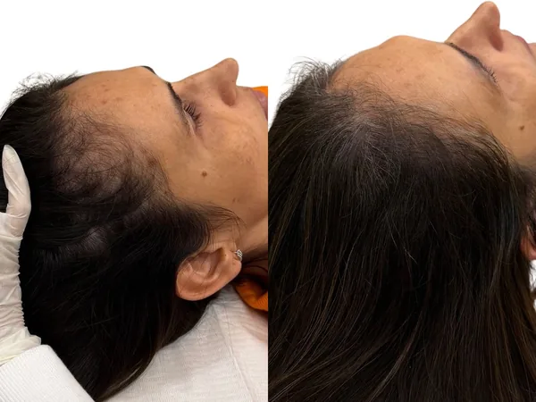 Comparativo da região frontoparietal em paciente com alopecia androgenética feminina