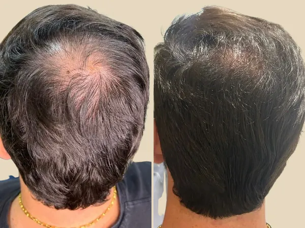 Comparativo da região da coroa em paciente com alopecia androgenética masculina