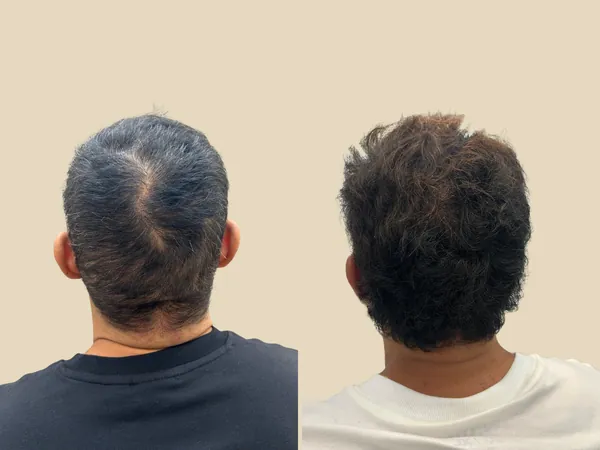 Comparativo da parte de trás da cabeça