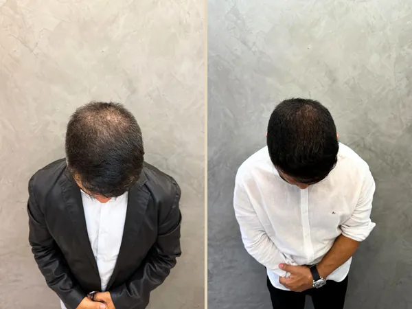 Comparativo do topo da cabeça visto de cima