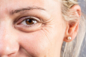 pes-de-galinha-nos-olhos-tratamento-na-clinica-follum-em-campo-grande-scaled.jpg