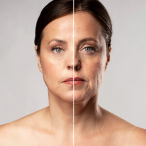 flacidez facial em campo grande