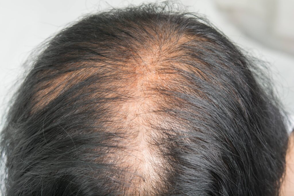 O que é Alopecia androgenética