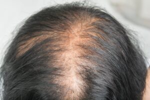 O que é Alopecia androgenética